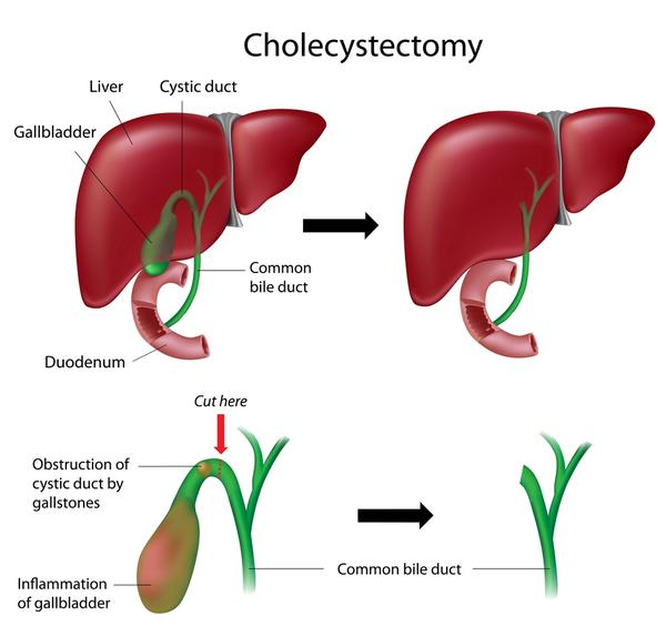 Laparoscopic gallbladder surgery in kalyan 