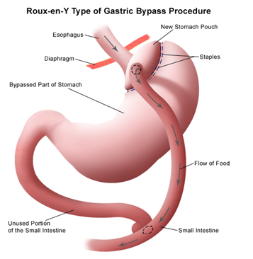 Laparoscopic Gastric By-Pass in Dombivli