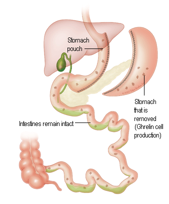 Laparoscopic Sleeve Gastrectomy in Kalyan