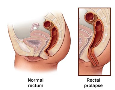  Expert Laparoscopic Surgeon for Rectal Prolapse