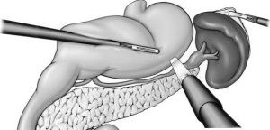 Laparoscopic for Splenectomy in Dombivli