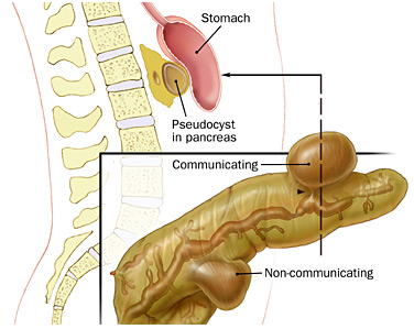 Pseudopancreatic Cysts Surgery in Dombivli