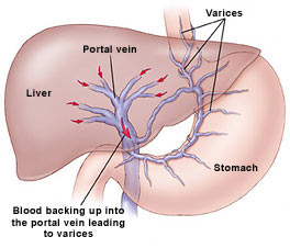 Portal Hypertension Surgery in dombivli