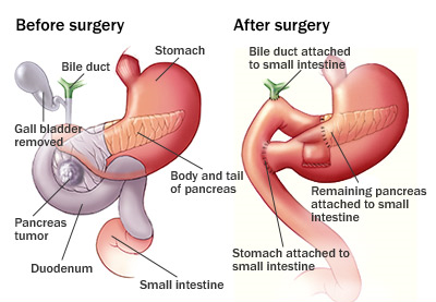 Whipple Procedure in Dombivli