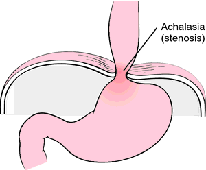 Laparoscopy for Achalasia Cardia in kalyan