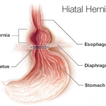 Laparoscopy for Hiatus Hernia in Dombivli