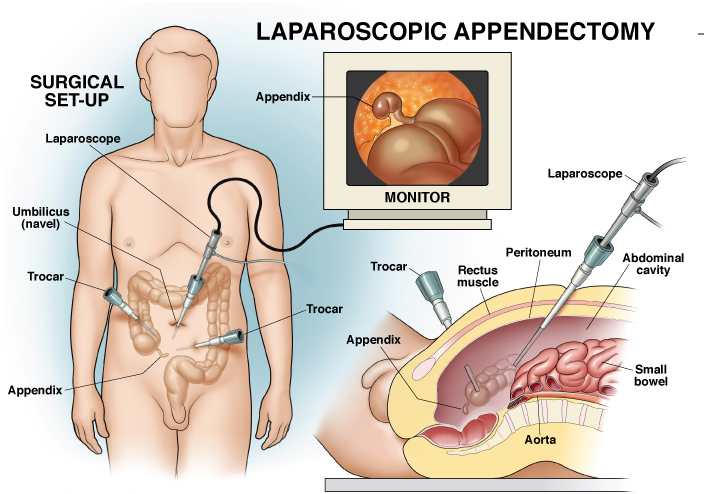 Laparoscopic Appendicectomy in kalyan
