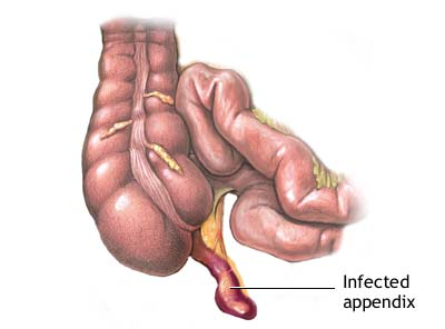 Laparoscopic Appendicectomy in Dombivli