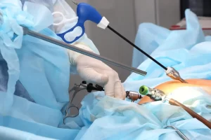 Laparoscopic Bariatric Surgeries